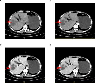 Dermatomyositis with intrahepatic cholangiocarcinoma: a case report and data mining based on machine learning